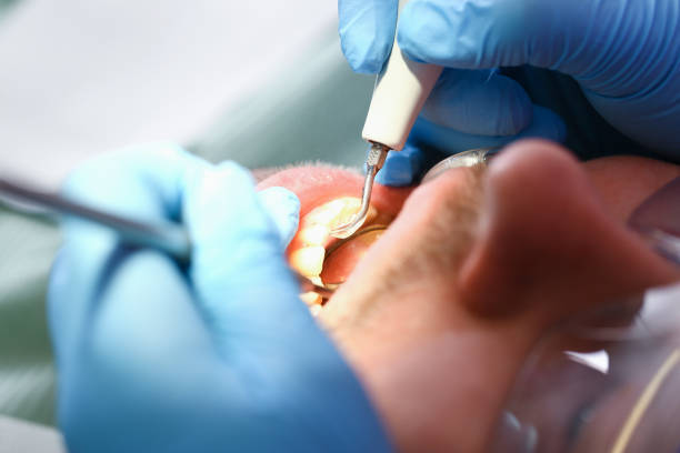 Best Emergency Tooth Extraction  in Micco, FL