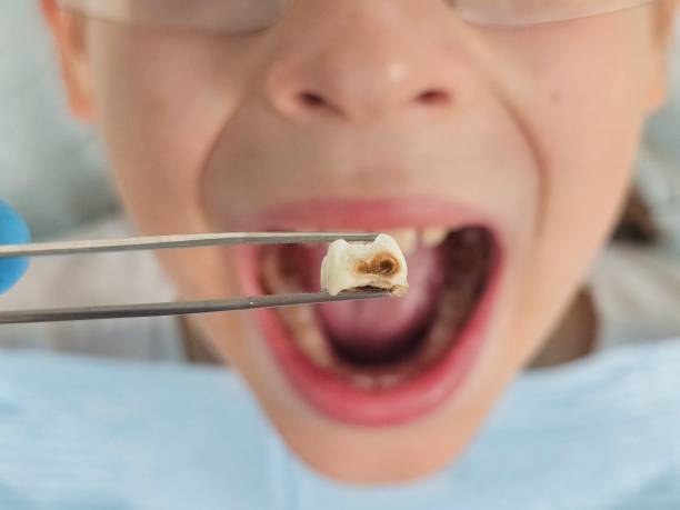 Best Knocked-Out Tooth Emergency  in Micco, FL
